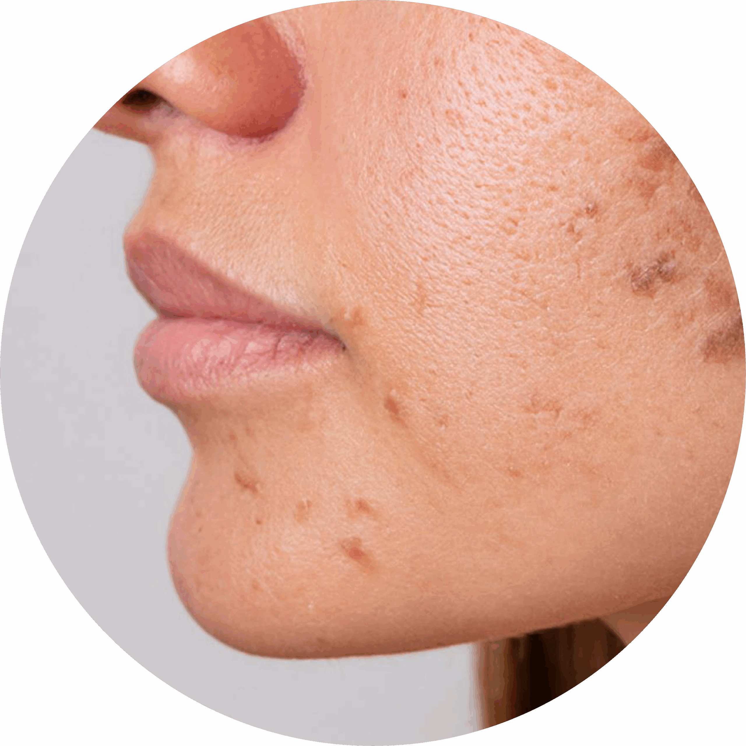 Overige pigmentvlekken